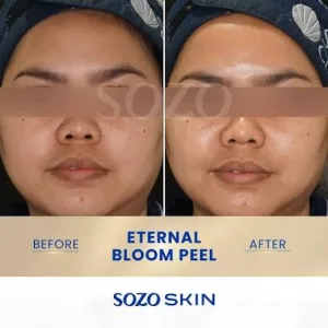 Hasil Eternal Bloom Peel
