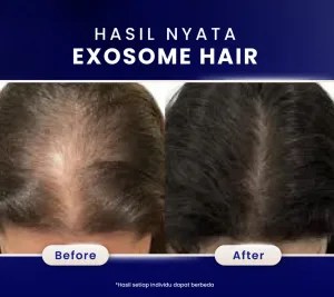 Hasil Exosome Hair Treatment di SOZO 