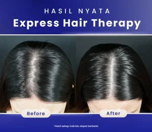 Hasil Express Hair Theraphy SOZO