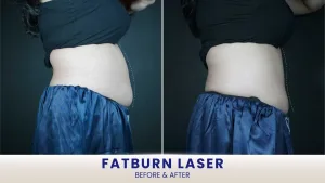 Hasil Fat Burn Laser