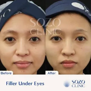 Hasul Filler Under Eyes