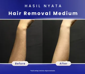 Before dan After Hair Removal Treatment SOZO