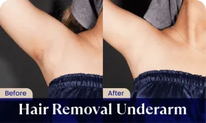 Hasil Underarm Hair Removal