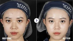 Hasil IPL di SOZO Skin Clinic | Sumber: Internal SOZO Skin Clinic