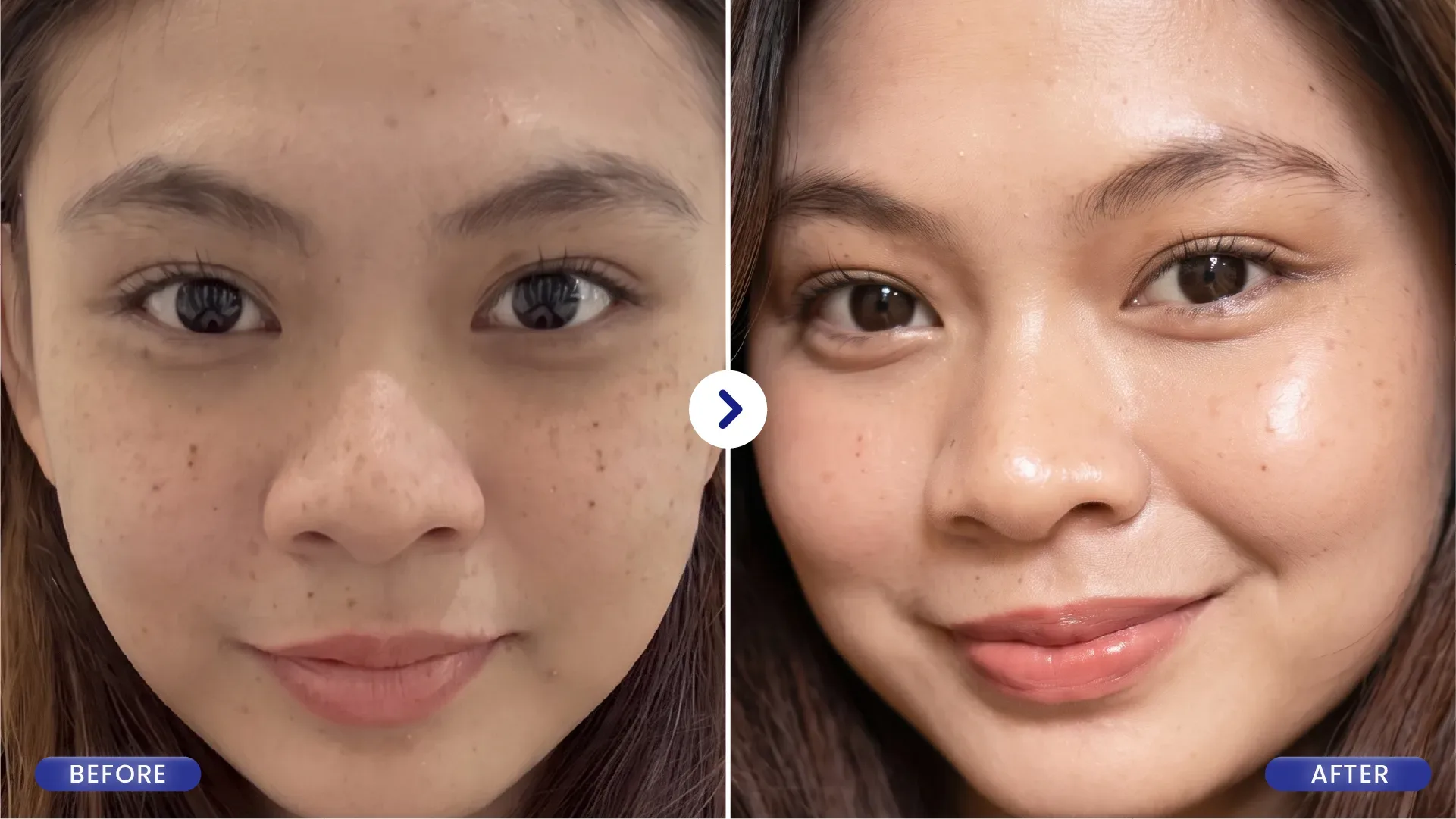 Cerahkan Wajah Lewat Terapi Cahaya, Kenapa IPL Glow Punya Downtime Singkat?