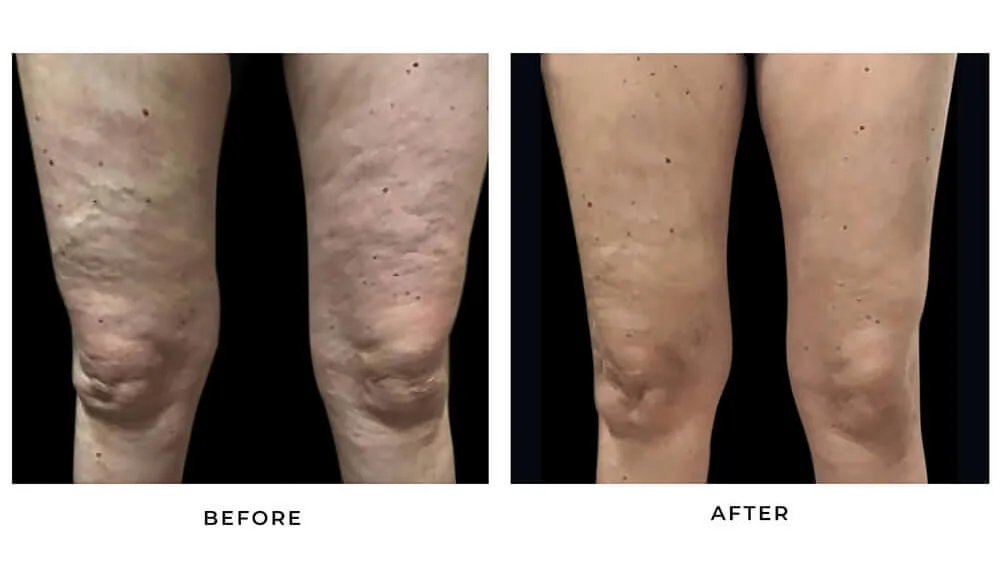 before after meso cellulift