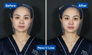 Hasil Meso V-Line