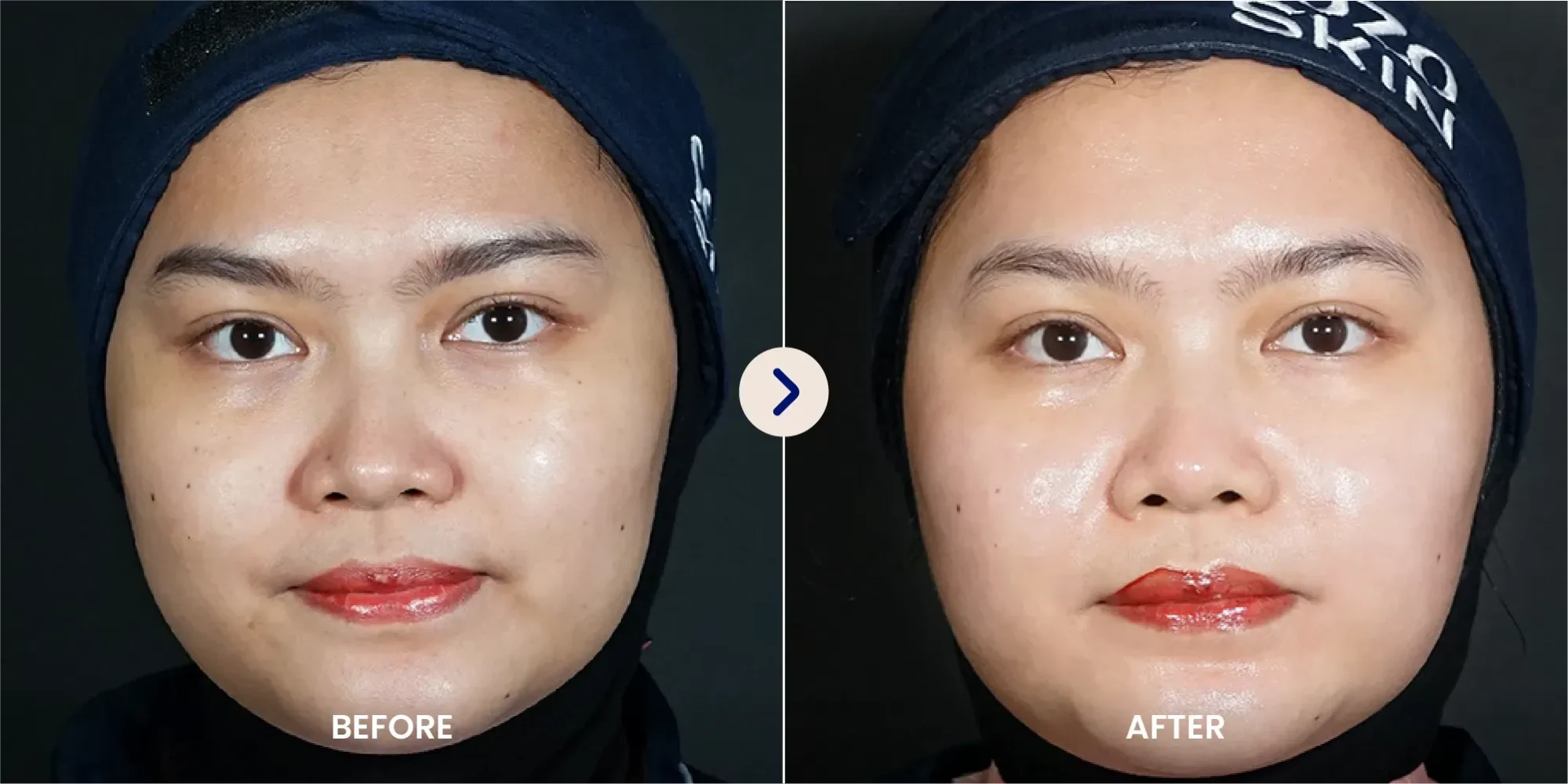 before after skin booster