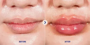 Hasil Pink Lips Laser