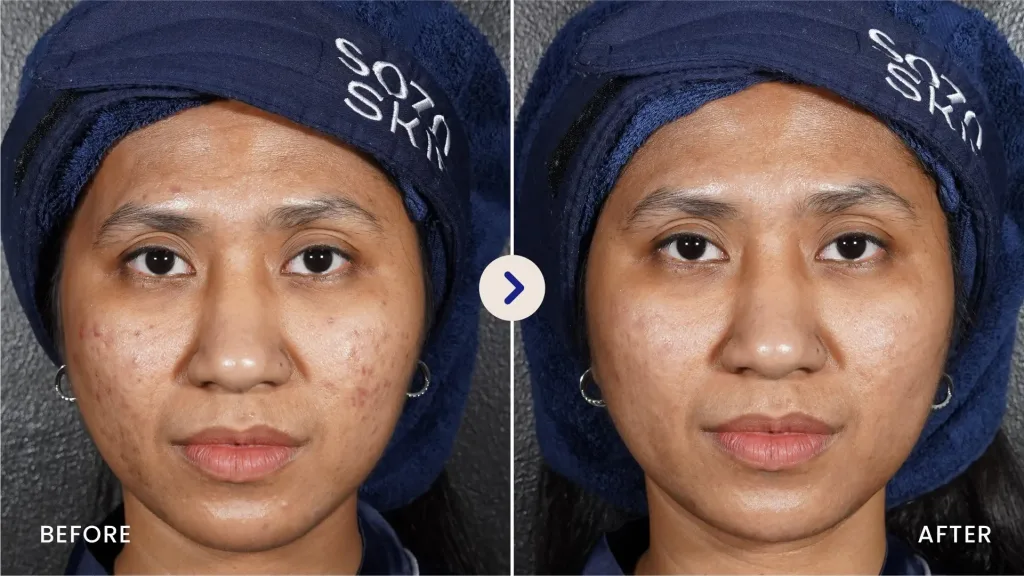 hasil pore detox treatment