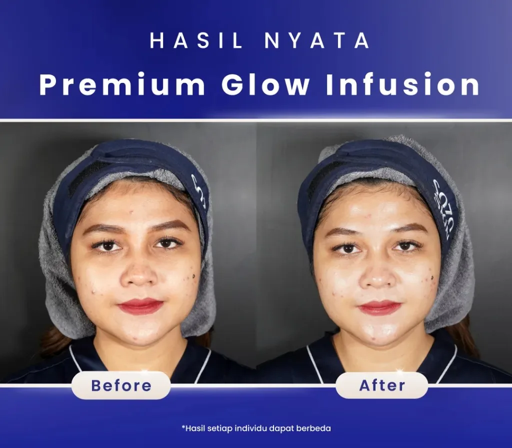 before after premium infusion