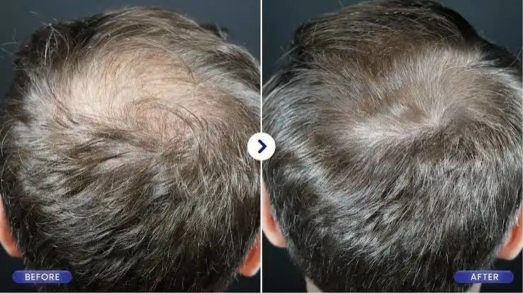 before after prp hair treatment