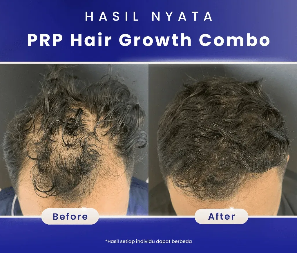 before after prp hair treatment