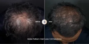 Hasil PRP Hair Treatment pada Kebotakan