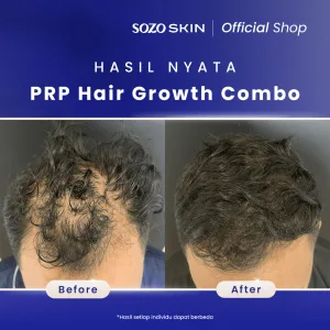 Hasil PRP Hair Treatment di SOZO Skin Clinic