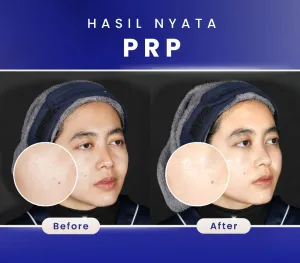 Hasil PRP Treatment di SOZO Skin Clinic