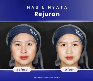 Hasil Rejuran di SOZO Skin Clinic