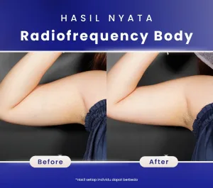 Hasil RF Body | Sumber: Internal SOZO Skin Clinic