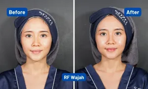 Hasil Radiofrequency Treatment SOZO 