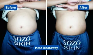 Hasil Mesotheraphy (Suntik Kurus) pada Perut