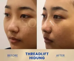Hasil Threadlift Hidung