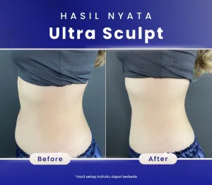 Hasil UltraSculpt di SOZO Skin Clinic