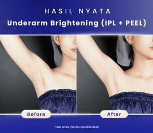 Hasil Underarm Brightening