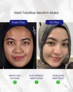 Hasil Facial SOZO Skin Clinic