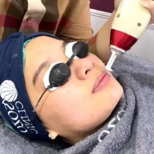 Prosedur Pink Lips Laser