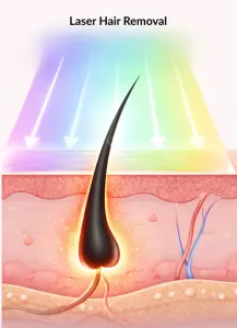 Cara Kerja Laser Ketiak | Sumber: Skin Bliss Med Spa