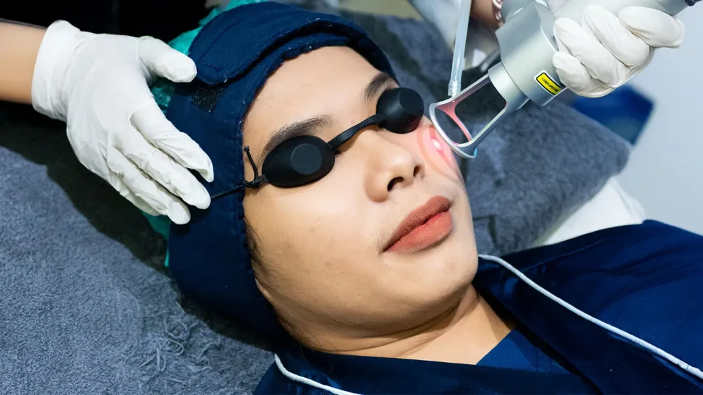 acne laser treatment