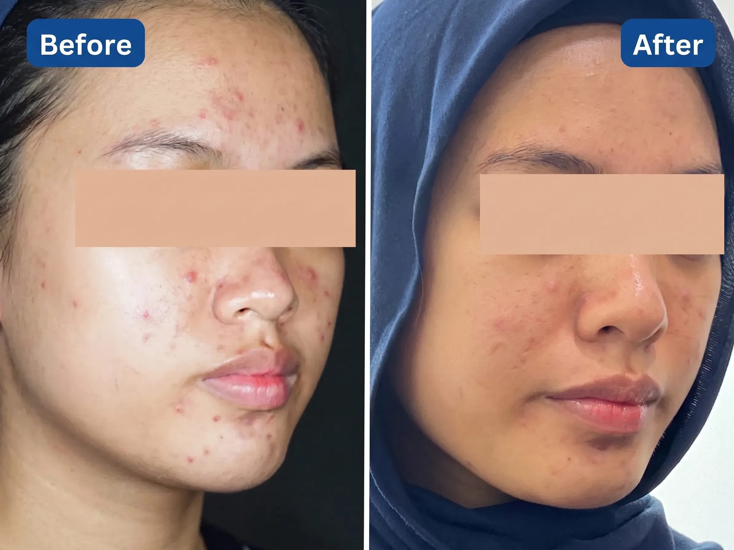 Before After Meso Acne Treatment Sozo