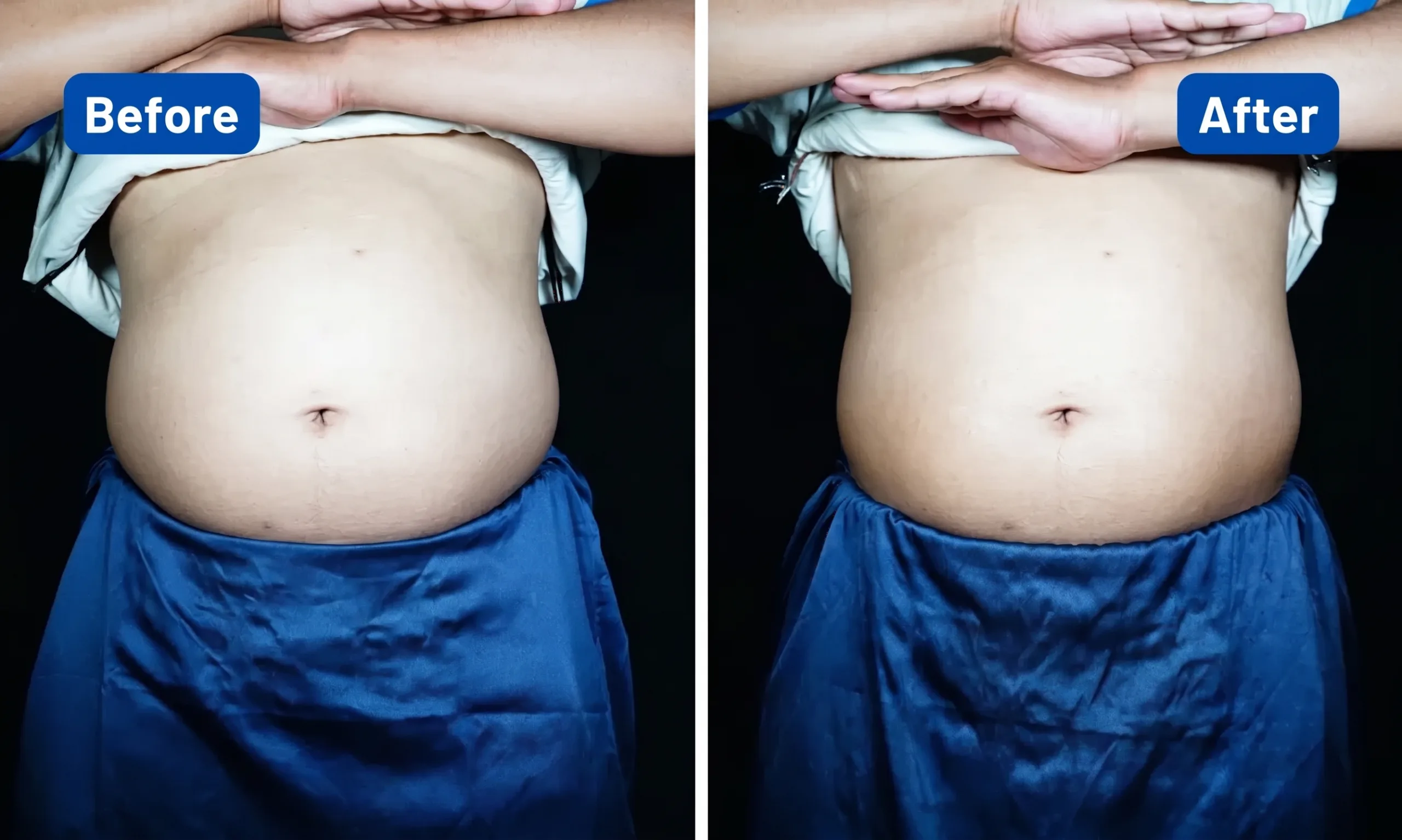 Before After Meso Treatment SOZO Skin Clinic 2