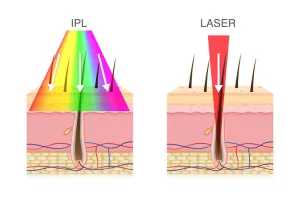 Perbedaan Jenis Cahaya yang Digunakan pada IPL dan Laser 