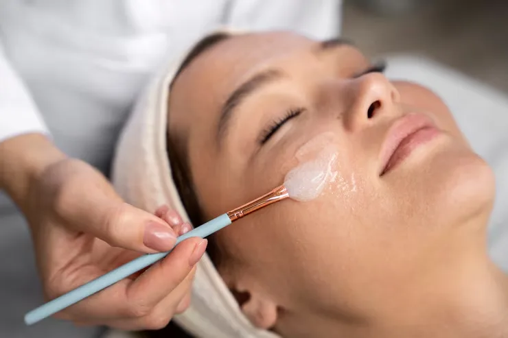 Ilustrasi Prosedur Acne Peel
