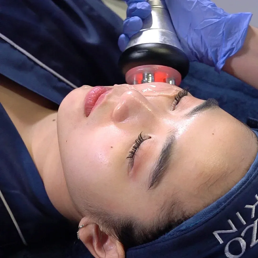 Hasil RF Treatment Tidak Instan, Lalu Kenapa Panas Bisa Merangsang Kolagen?