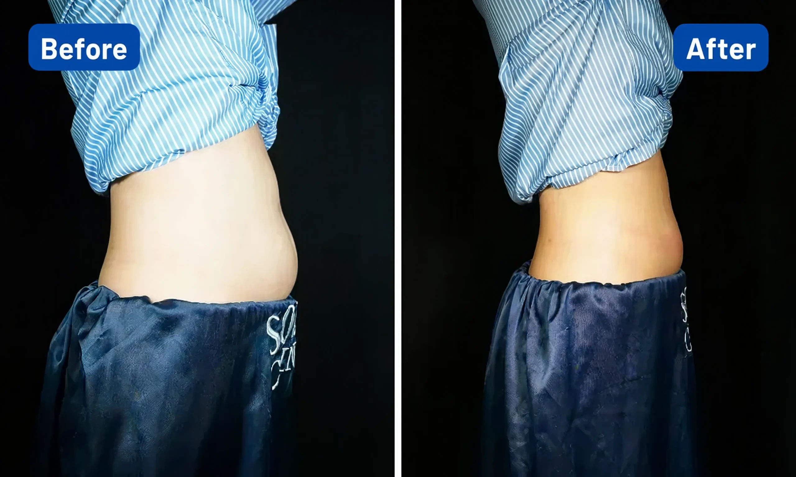 Before After Slimming Treatment SOZO Skin Clinic 1