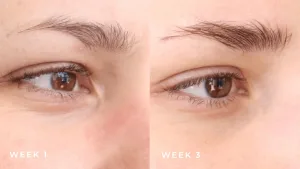 Brow Growth Therapy