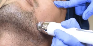 Cara Kerja Beard Treatment
