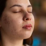 Jerawat Parah Harus ke Klinik atau Cukup di Rumah? Kenali Pilihan Treatment dari Facial hingga Laser