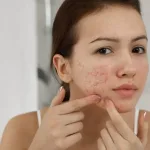 7 Cara Menghilangkan Bopeng di Pipi dan Pilihan Perawatannya