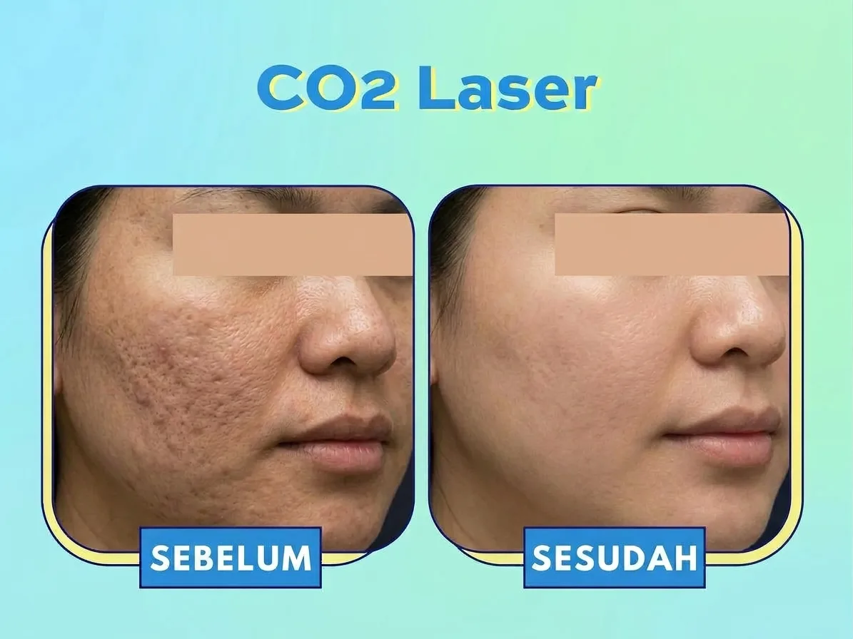 Hasil Sebelum dan Sesudah Laser CO2 SOZO 2