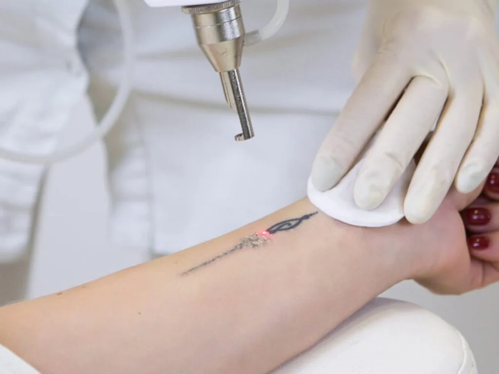 Laser Tattoo Removal