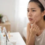 Muncul Jerawat Setelah Skin Booster, Normal Nggak?