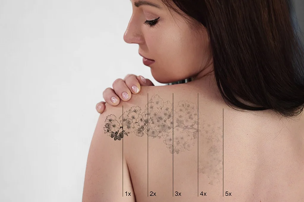 Tattoo Removal