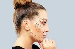 Ilustrasi Area Thread Lift