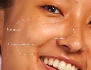 Beda Sun Spot, Melasma, atau Freckles
