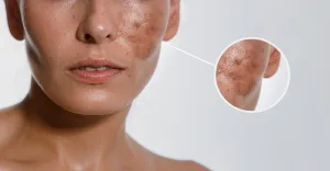 Ilustrasi Bekas Jerawat