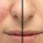 Laser vBeam untuk Apa? Ini Keluhan Kulit yang Cocok dan yang Tidak