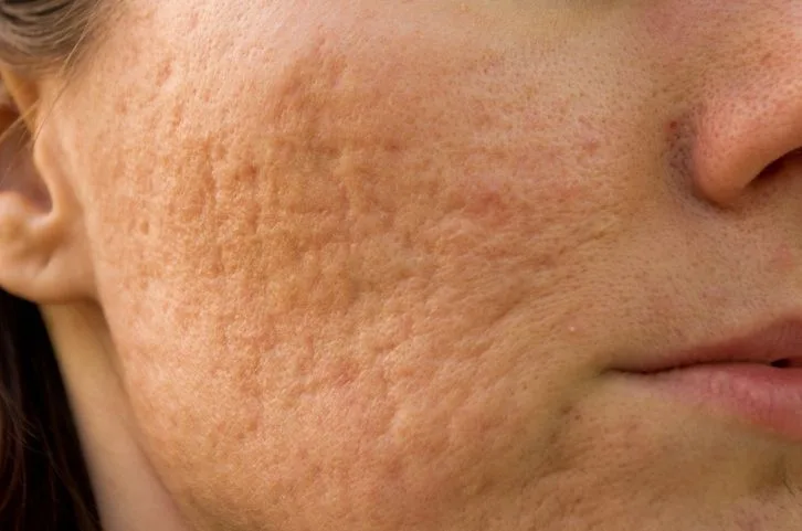Apakah Bopeng Bisa Hilang dengan Skincare? Ini Jawaban Jujurnya